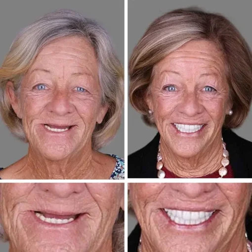 🌎Ends Today: 60% OFF! ⏰ Medical Full Denture with Strong Suctiond🦷Obtain American Dental Association (ADA) Certification