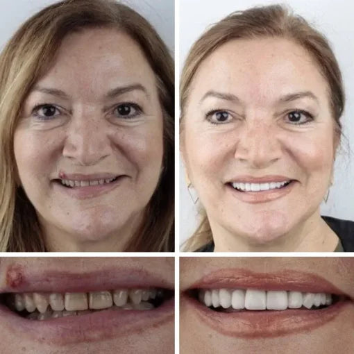 🌎Ends Today: 60% OFF! ⏰ Medical Full Denture with Strong Suctiond🦷Obtain American Dental Association (ADA) Certification