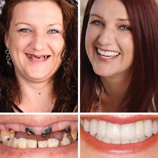 🌎Ends Today: 60% OFF! ⏰ Medical Full Denture with Strong Suctiond🦷Obtain American Dental Association (ADA) Certification